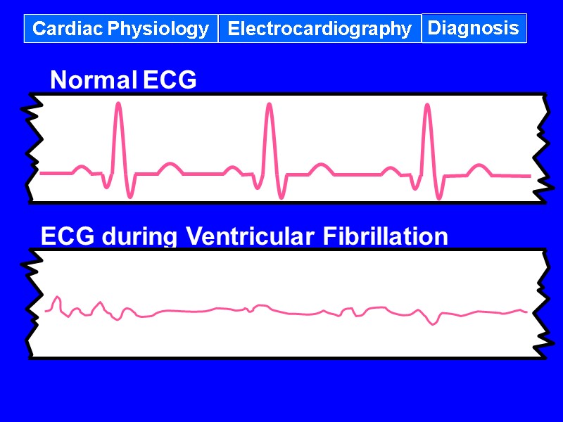 Cardiac Physiology Electrocardiography Diagnosis ECG during Ventricular Fibrillation Normal ECG